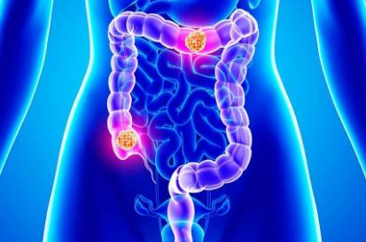 注意!结肠癌常被误诊为这些良性病