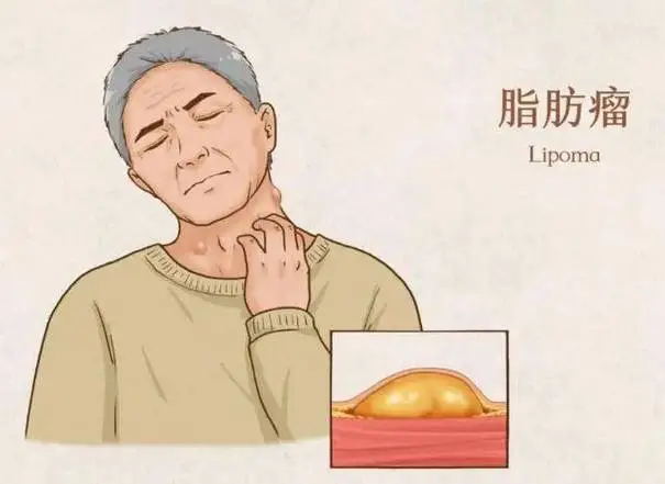 认识脂肪瘤，远离健康小困扰