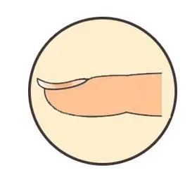 指甲的异常形态:疾病的 “求救信号”(图2) 640 (1)_看图王.web.jpg