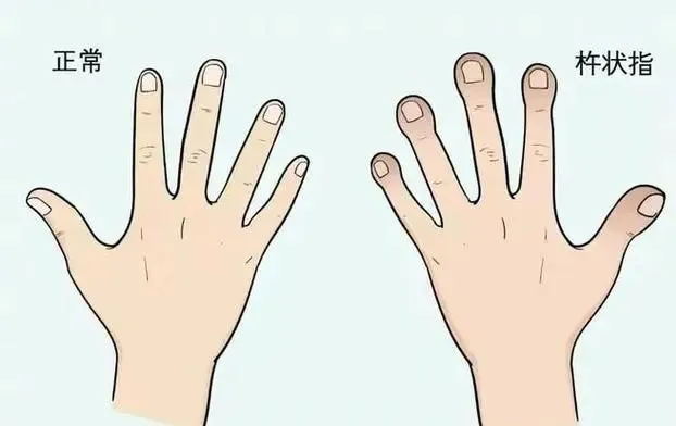 指甲的异常形态:疾病的 “求救信号”(图3) 640 (2)_看图王.web.jpg