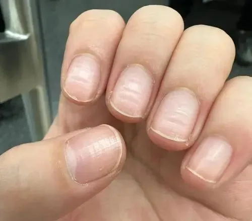 指甲的异常形态:疾病的 “求救信号”(图5) 640 (4)_看图王.web.jpg