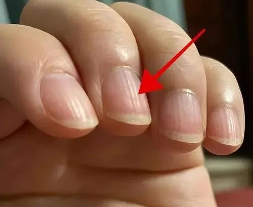 指甲的异常形态:疾病的 “求救信号”(图6) 640 (5)_看图王.web.jpg