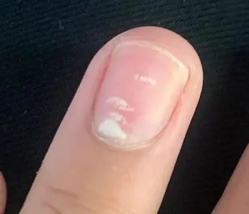 指甲的异常形态:疾病的 “求救信号”(图7) 640 (6)_看图王.web.jpg