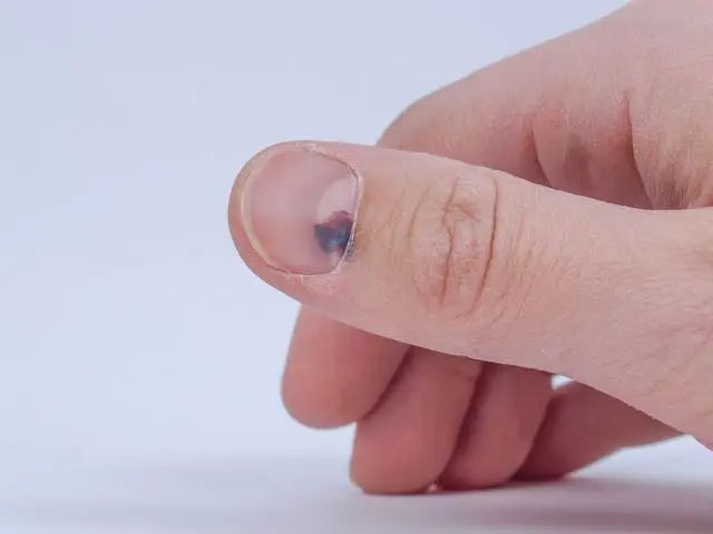 指甲的异常形态:疾病的 “求救信号”(图8) 640 (7)_看图王.web.jpg