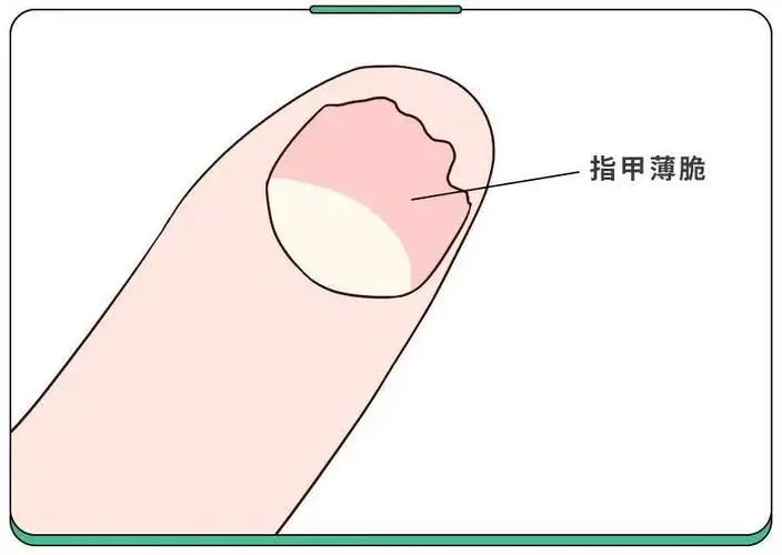 指甲的异常形态:疾病的 “求救信号”(图9) 640 (8)_看图王.web.jpg