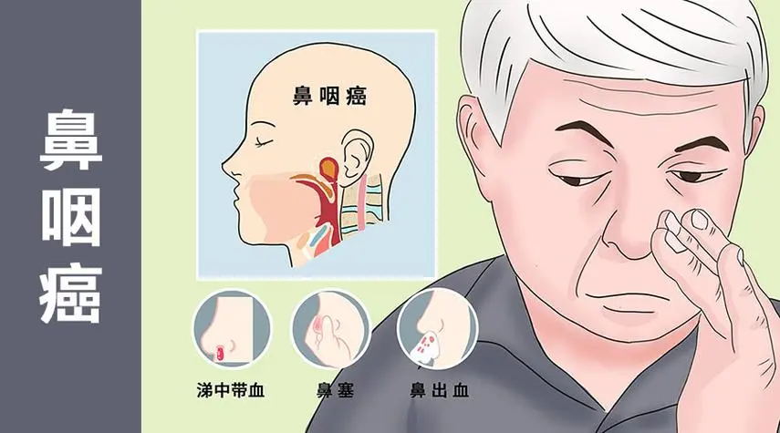 ‘鼻炎’还是‘鼻咽癌’?如何区分,一招教你识别!(图5) 640 (18)_看图王.web.jpg