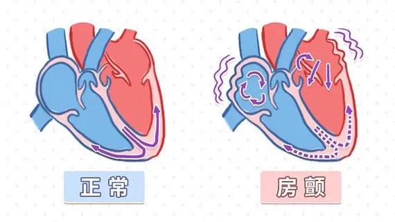 心跳乱跳可能是心脏在求救！房颤的3个沉默信号，中一个快就医