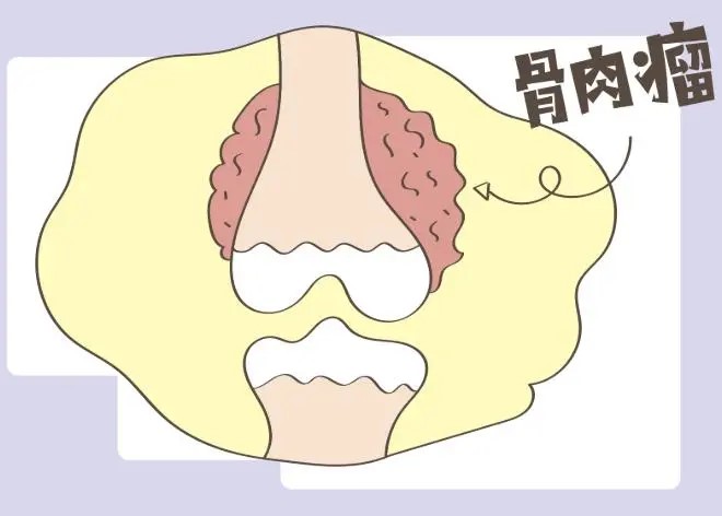 骨肉瘤：容易被误诊为 “生长痛” 的隐形杀手！