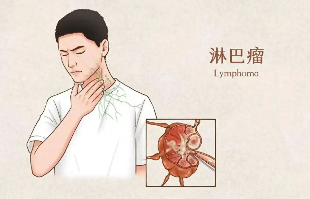 淋巴结肿大不痛不痒？可能是淋巴瘤的 “沉默信号”！