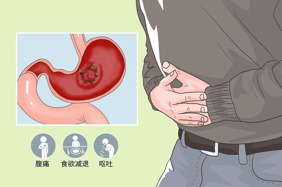 胃痛≠胃炎!医生警告:这种 “隐隐作痛” 可能是胃癌信号