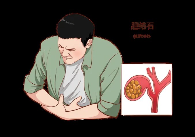 "右上腹突然剧痛?别当胃病治!胆结石发作的3个致命信号"