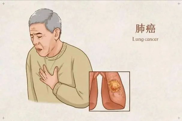 不咳嗽、不胸痛,我的肺癌为何一发现就是晚期?