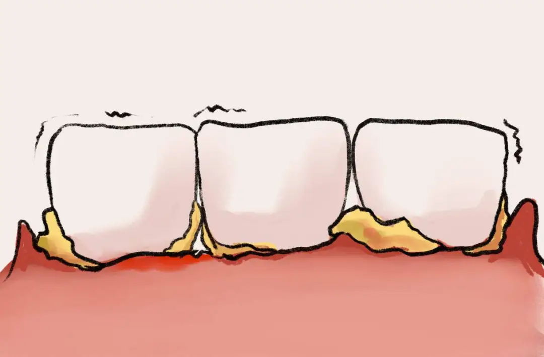 刷牙见血别当小事!牙龈出血可能是身体在“报警”(图2) 640 (5)_看图王.web.jpg