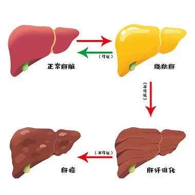 脂肪肝是肝脏的“隐形炸弹”!放任不管的后果比肝癌更可怕?(图3) 640 (8)_看图王.web.jpg