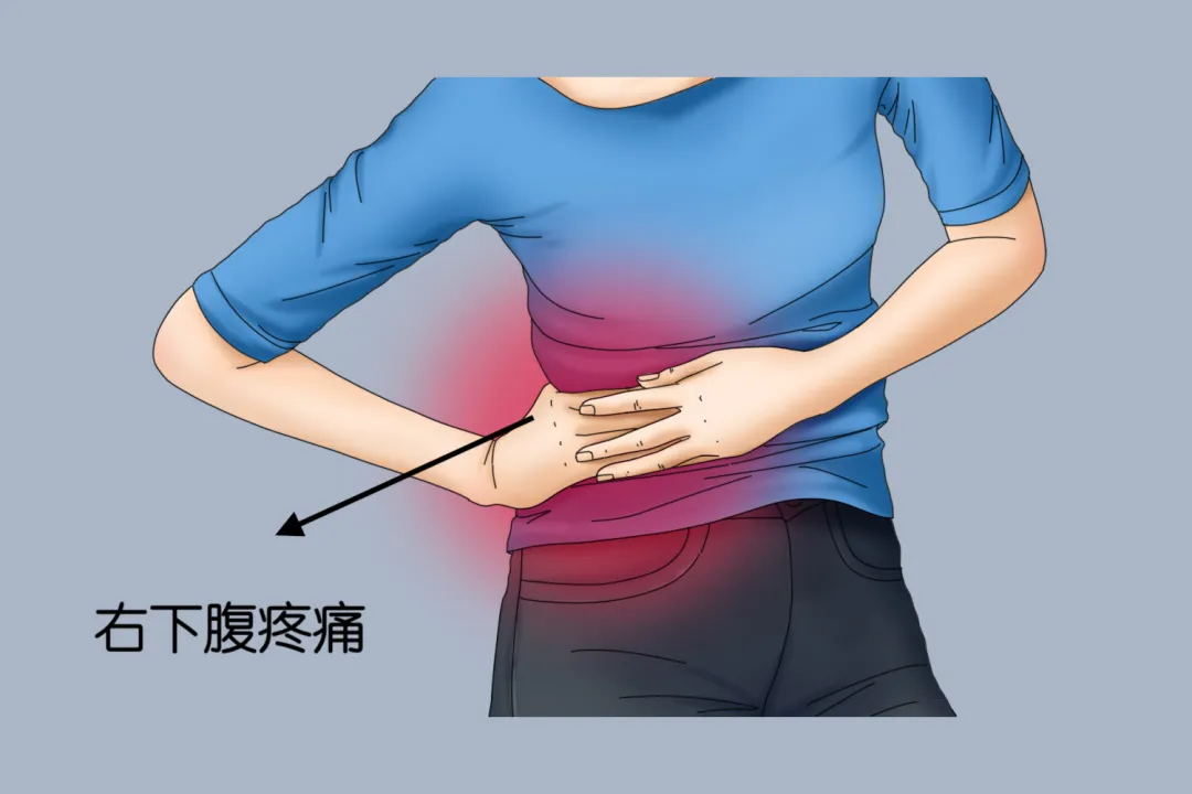 右下腹突然剧痛?可能是身体里的"定时炸弹"在报警!