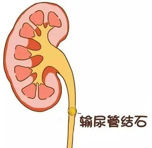 右下腹突然剧痛?可能是身体里的"定时炸弹"在报警!(图4) 640 (3)_看图王.web.jpg