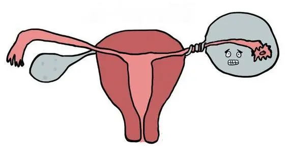 右下腹突然剧痛?可能是身体里的"定时炸弹"在报警!(图5) 640 (2)_看图王.web.jpg