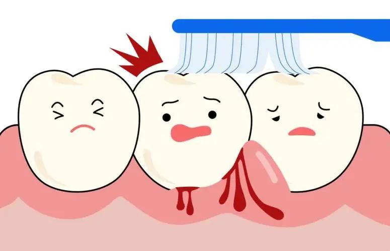 每天刷牙出血?你可能正在‘喂养’牙周炎细菌!