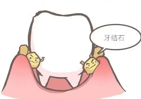 每天刷牙出血?你可能正在‘喂养’牙周炎细菌!(图2) 640 (11)(1).jpg