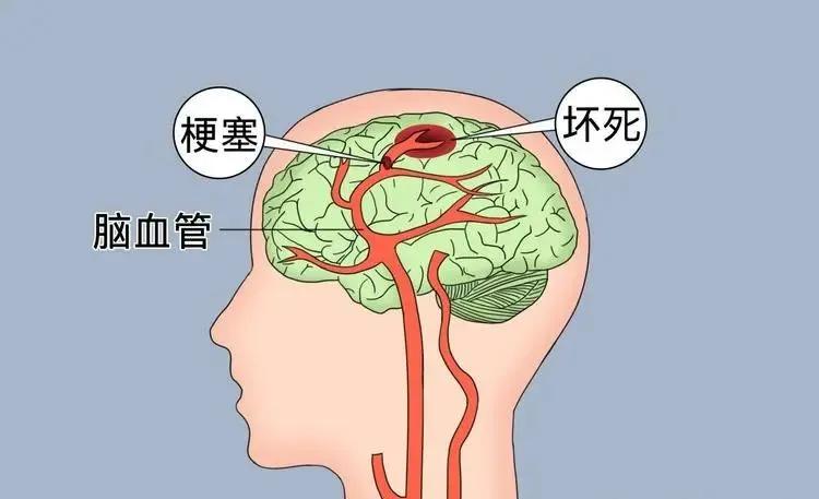 睡前若有这5种表现,可能是脑梗在“预警”,很多人都忽视了!