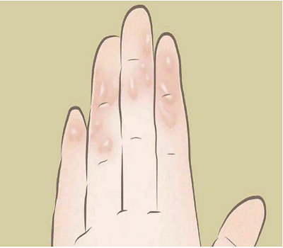 夏天这4个部位出汗多,可能暗藏健康隐患!(图3) 640.png