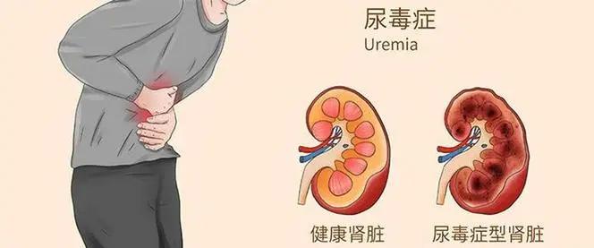 尿毒症盯上年轻人?这些习惯正在悄悄毁掉你的肾