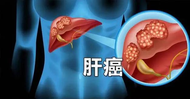 腿痒2个月,竟查出肝癌!医生提醒:身体这2处发痒要当心! (图2) 640 (15)(1).jpg