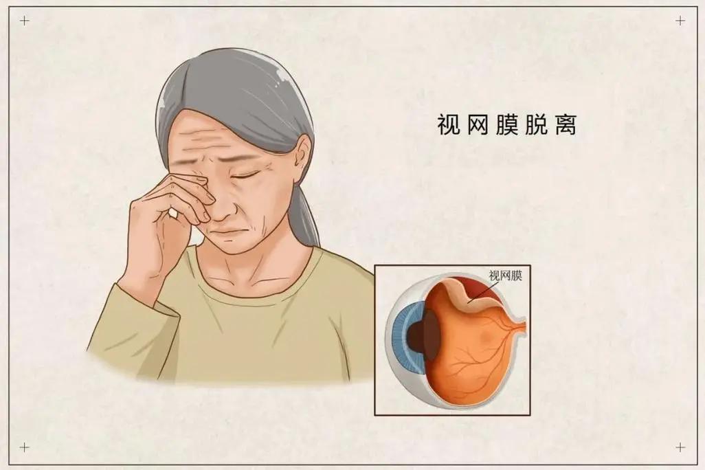 近视度数超过这个“临界点”,眼部疾病风险会骤升?真不是危言耸听(图3) 640 (12)(1).jpg