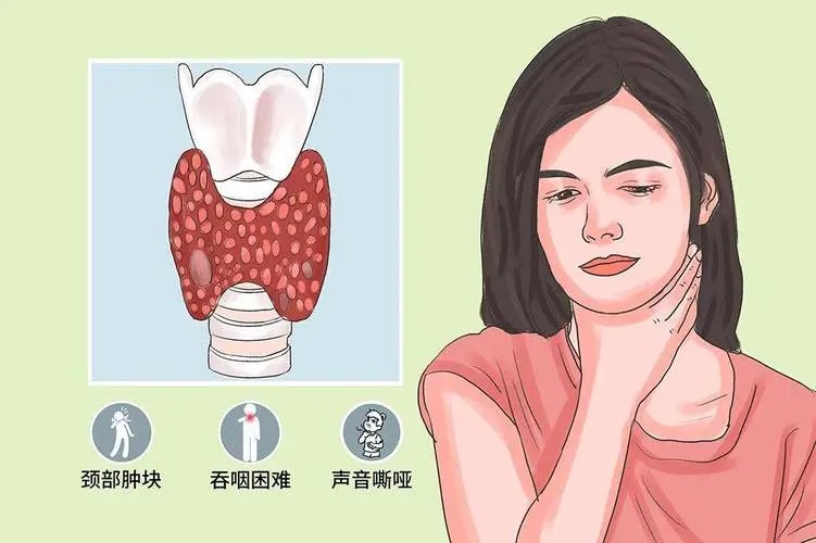 甲状腺癌早期不是脖子疼,而是身上6种异常(图8) 640 (25).jpg