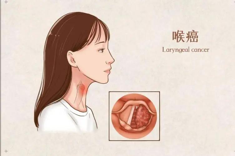 喉咙出现这三种症状别大意!可能是喉癌信号,别再当咽炎拖了