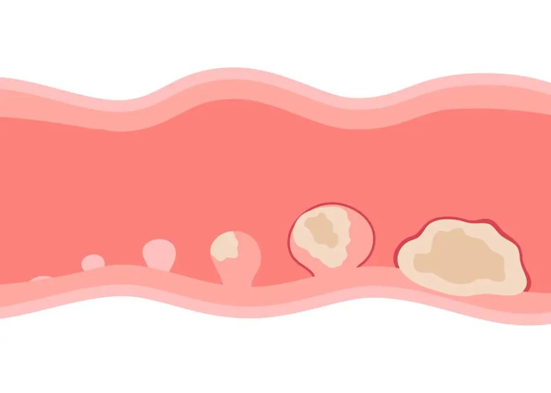 体检报告出现这几个字,距离癌症可能只有“一步之遥”!(图4) 640 (8)(1).jpg