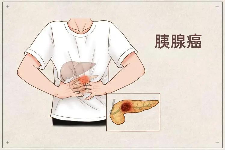 死亡率第一的癌症:胰腺癌,早期为何难发现?