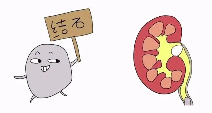 还吃?这些食物会加速结石形成