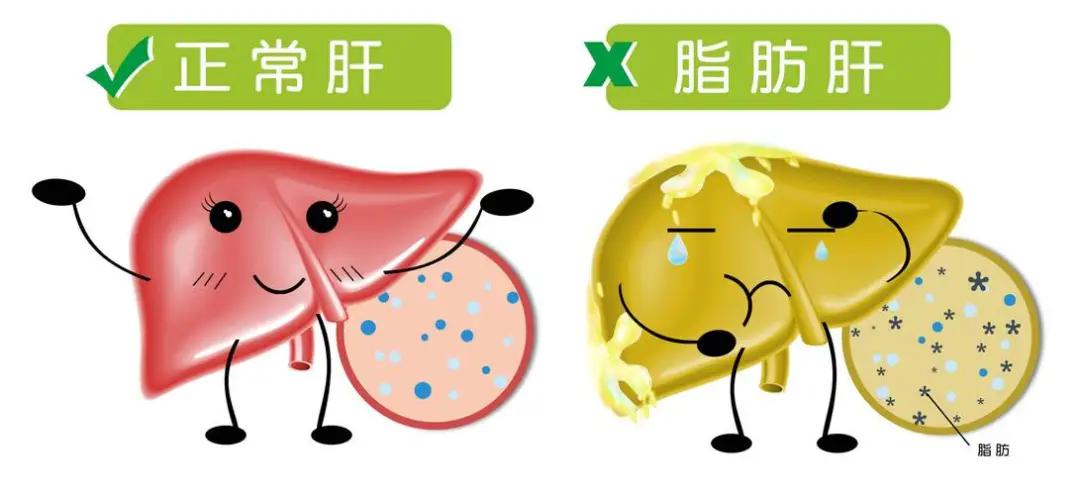 体检报告上“脂肪肝”三个字,别以为不痛不痒就没关系!(图2) 640 (5)(1).jpg